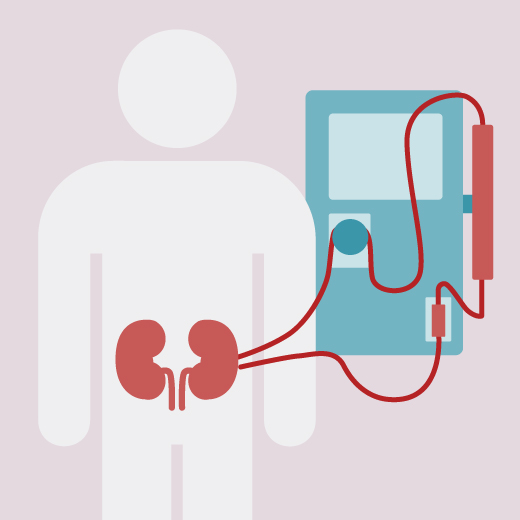 Graphic illustration of the dialysis process